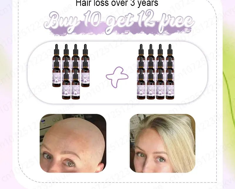 Hair growth essential oil. Effectively repairs baldness and hair loss symptoms, suitable for both men and women Hair growth essential oil. Effectively repairs baldness and hair loss symptoms, suitable for both men and women