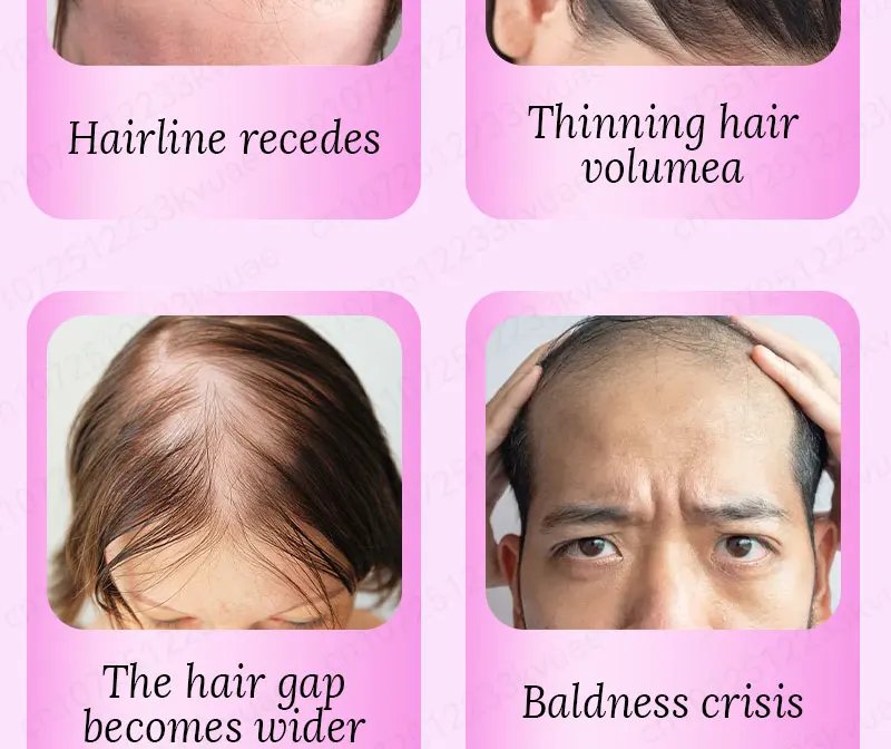 Hair growth essential oil. Effectively repairs baldness and hair loss symptoms, suitable for both men and women Hair growth essential oil. Effectively repairs baldness and hair loss symptoms, suitable for both men and women