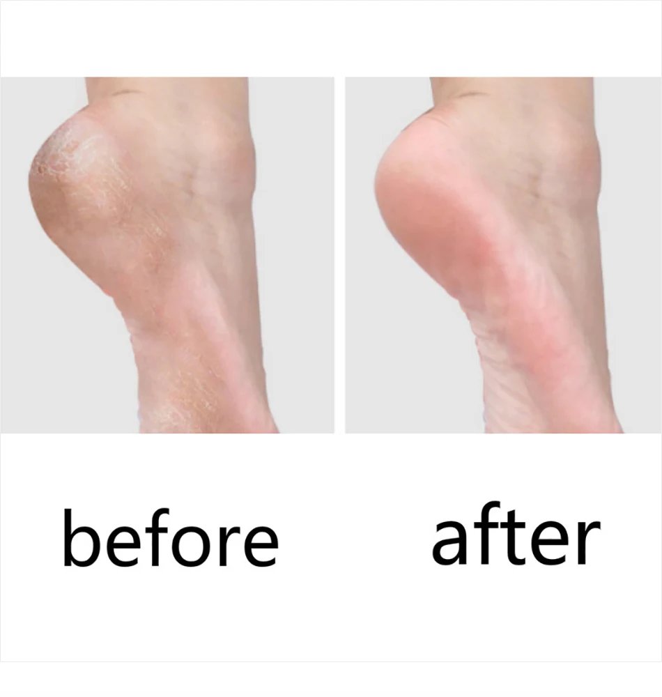 Pedicure Knife Tools for Feet Stainless Steel Foot Scrubber Dead Skin Remover 1/2/5Pcs Foot Scraper Knife Scraping Manicure Tool Pedicure Knife Tools for Feet Stainless Steel Foot Scrubber Dead Skin Remover 1/2/5Pcs Foot Scraper Knife Scraping Manicure Tool