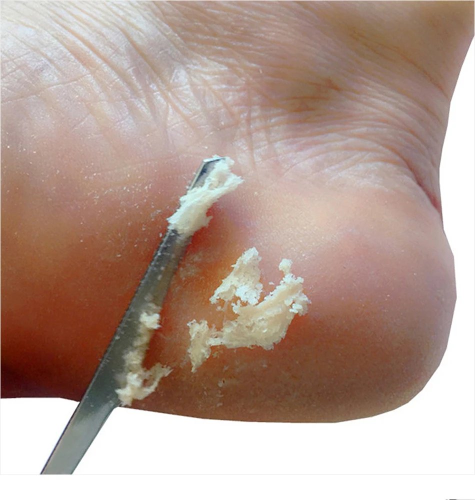 Pedicure Knife Tools for Feet Stainless Steel Foot Scrubber Dead Skin Remover 1/2/5Pcs Foot Scraper Knife Scraping Manicure Tool Pedicure Knife Tools for Feet Stainless Steel Foot Scrubber Dead Skin Remover 1/2/5Pcs Foot Scraper Knife Scraping Manicure Tool