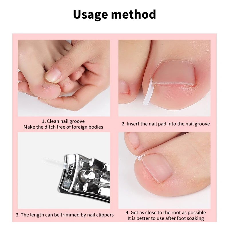 50pcs Ingrown Toenail Correction Tool Invisible Ingrown Toe Nail Treatment Pad Groove Straightening Clip Brace Foot Care Tool